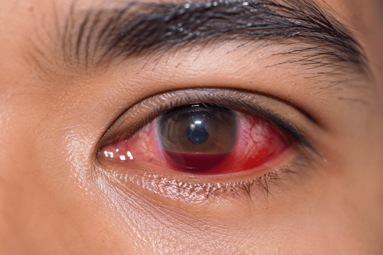 Mengenal Hyphema, Perdarahan pada Mata yang Tidak Boleh Diabaikan