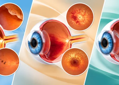 ilustrasi penyakit retina