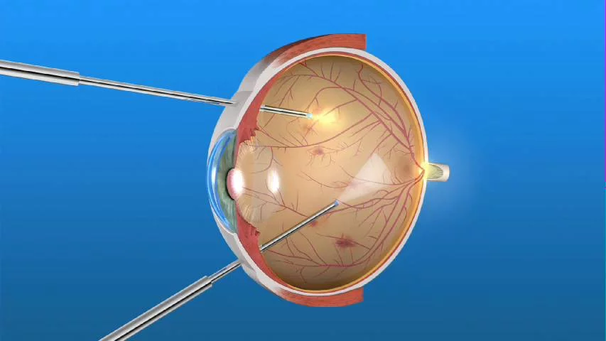 Глаз после лазерной коагуляции сетчатки. Гемофтальм стекловидного тела. Гемофтальм офтальмоскопия. Отслойка сетчатки витрэктомия. Секторальная лазеркоагуляция сетчатки.